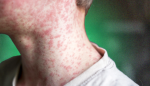 US measles outbreak 2026 has renewed focus on childhood vaccination like the one shown here
