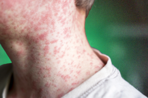 US measles outbreak 2026 has renewed focus on childhood vaccination like the one shown here