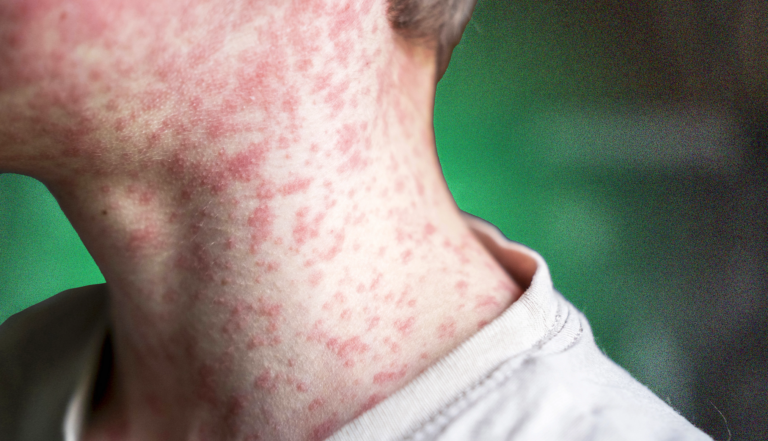 US measles outbreak 2026 has renewed focus on childhood vaccination like the one shown here