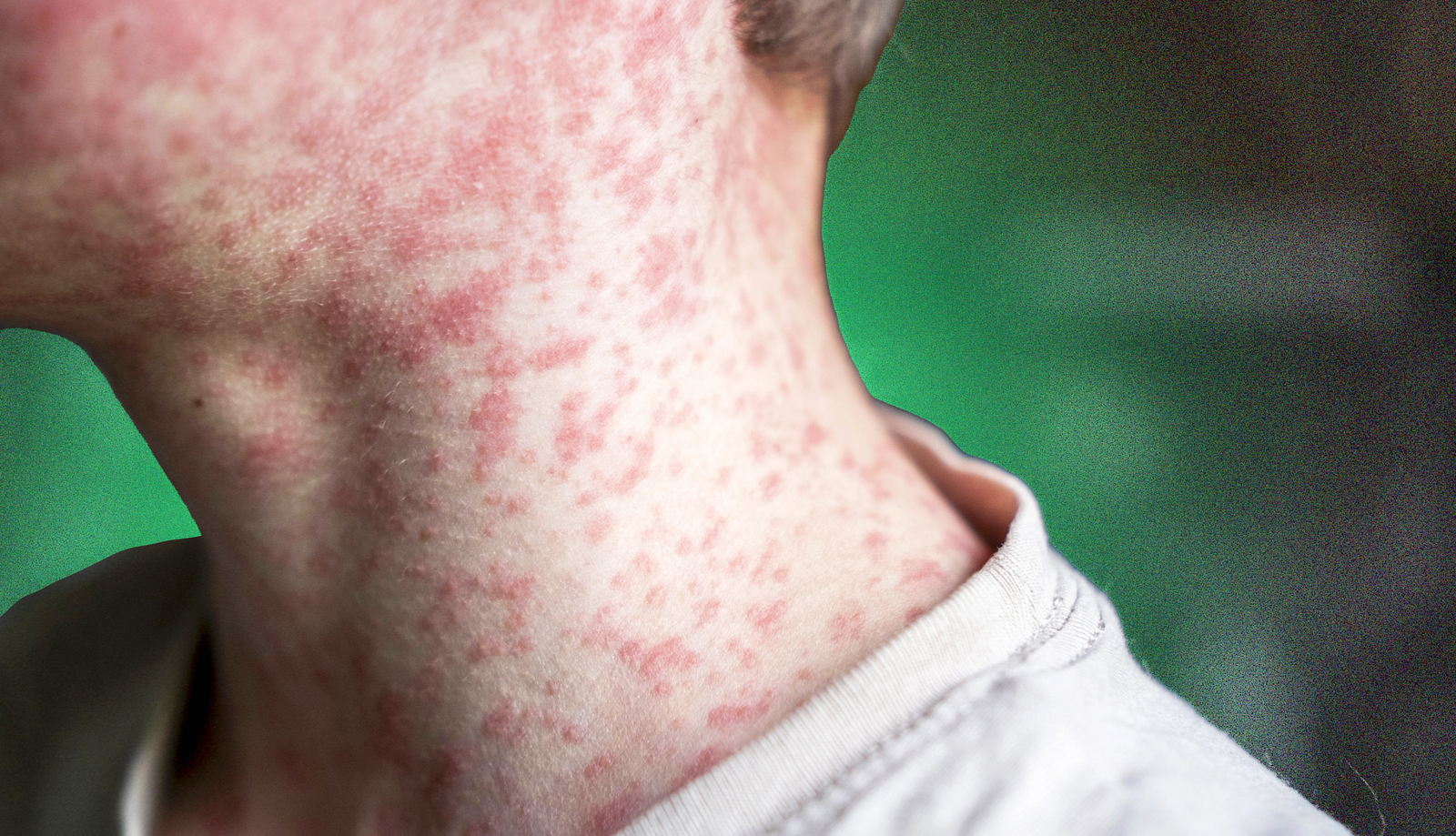 US measles outbreak 2026 has renewed focus on childhood vaccination like the one shown here